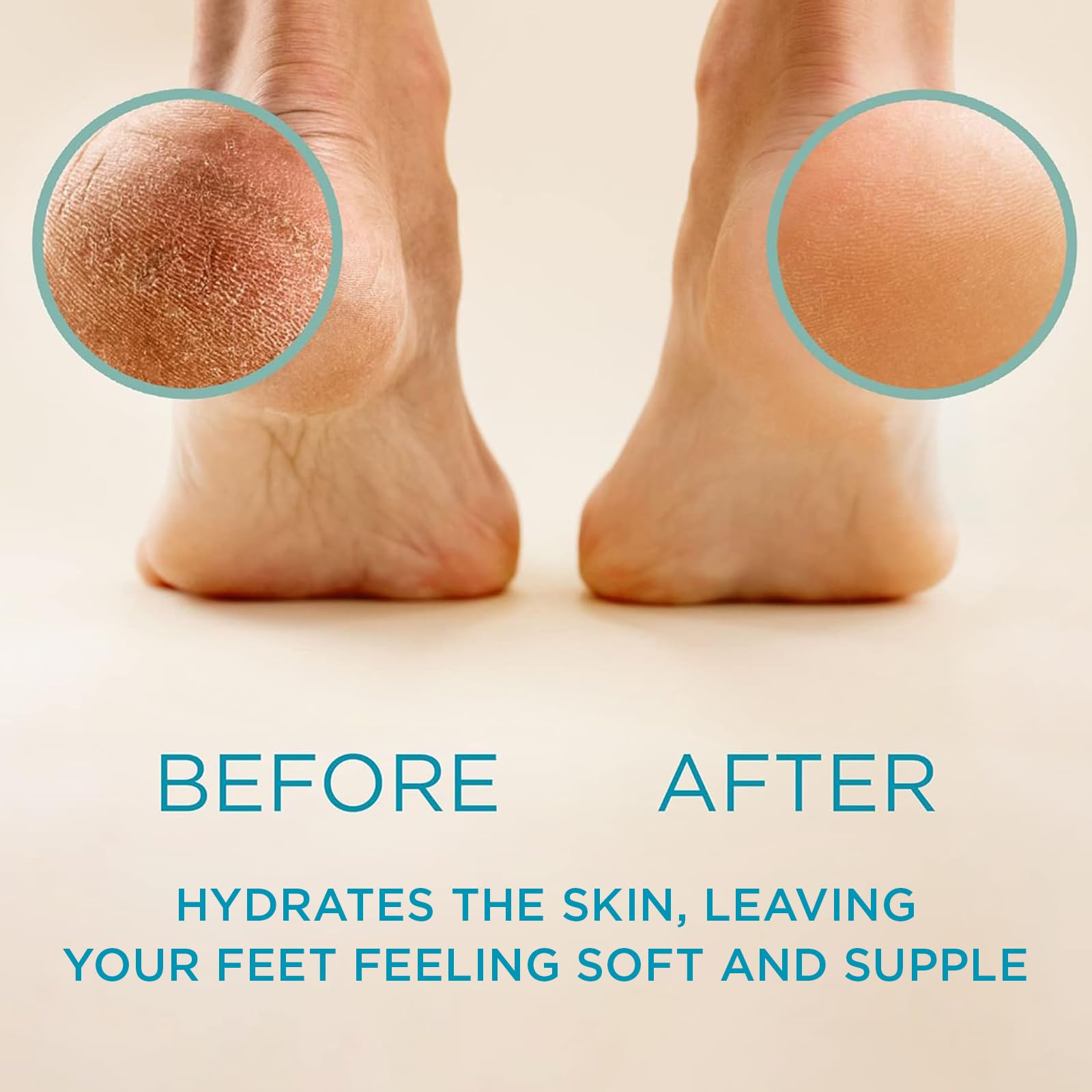 16oz Best Callus Remover.Callus Eliminator,Liquid & Gel For Corn And Callus On Feet. Professional Grade, Does Better Job Than Electric Shaver&Other Scary Tools